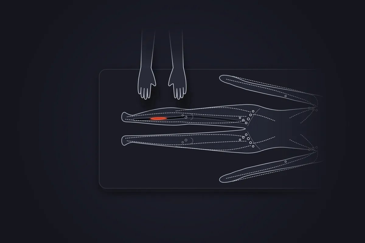 Illustration&nbsp;: jambes d'un patient allongé sur une table de soin, vues de dessus. Une veine profonde du mollet droit, dessinée en trait sombre, contient un petit caillot rouge&nbsp;: c'est une phlébite (thrombose veineuse profonde). Le mollet est légèrement gonflé. Les mains du kinésithérapeute restent levées au-dessus de la jambe, sans la toucher. Le réseau lymphatique est dessiné en gris.