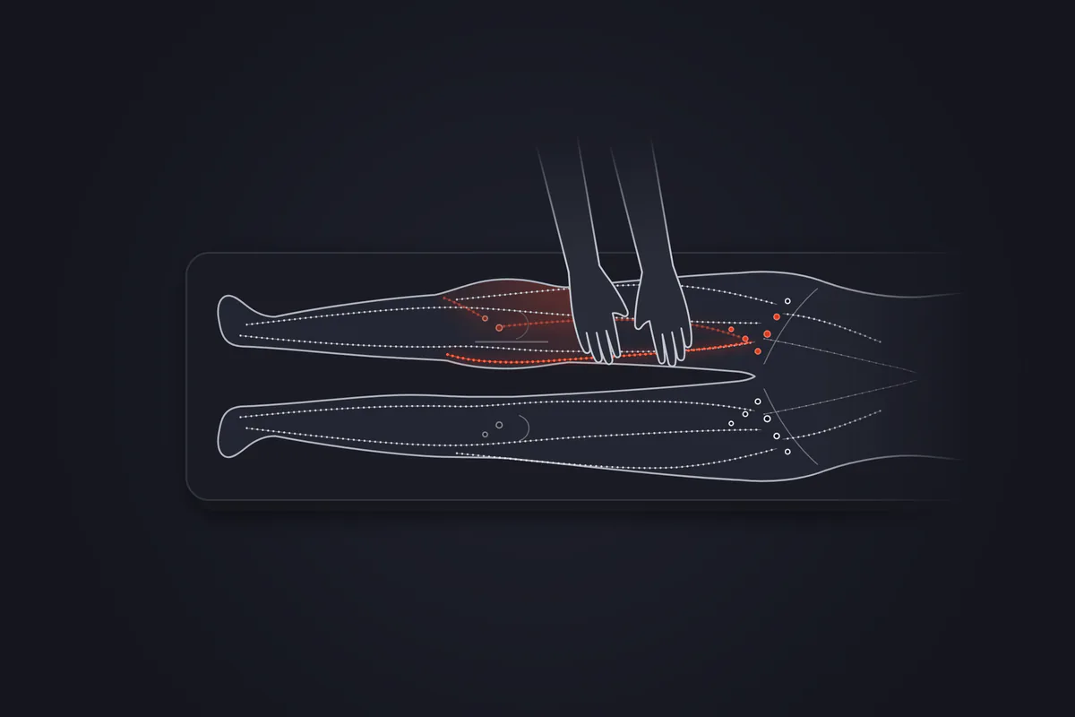 Illustration&nbsp;: jambes d'un patient allongé sur le dos, vues de dessus, genou droit gonflé avec une fine cicatrice longitudinale de prothèse. Les mains du kinésithérapeute sont posées sur la cuisse au-dessus du genou. Un tracé rouge conduit la lymphe du genou vers les ganglions du creux du genou puis de l'aine, et, en surface, le long de la face interne de la cuisse jusqu'à l'aine.