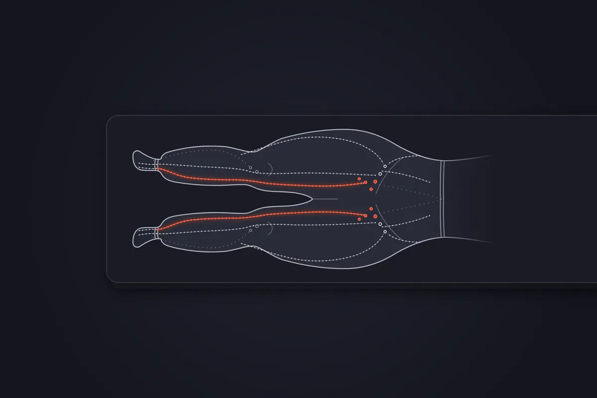 Illustration&nbsp;: jambes d'une patiente allongée sur le dos, vues de dessus. Les hanches, les cuisses, les genoux et les mollets sont élargis de façon symétrique et s'arrêtent net au-dessus des chevilles, avec des pieds fins épargnés. Un collant de compression est suggéré de la taille aux chevilles. Le trajet de la lymphe, en rouge, remonte par la face interne des deux jambes jusqu'aux ganglions de l'aine.