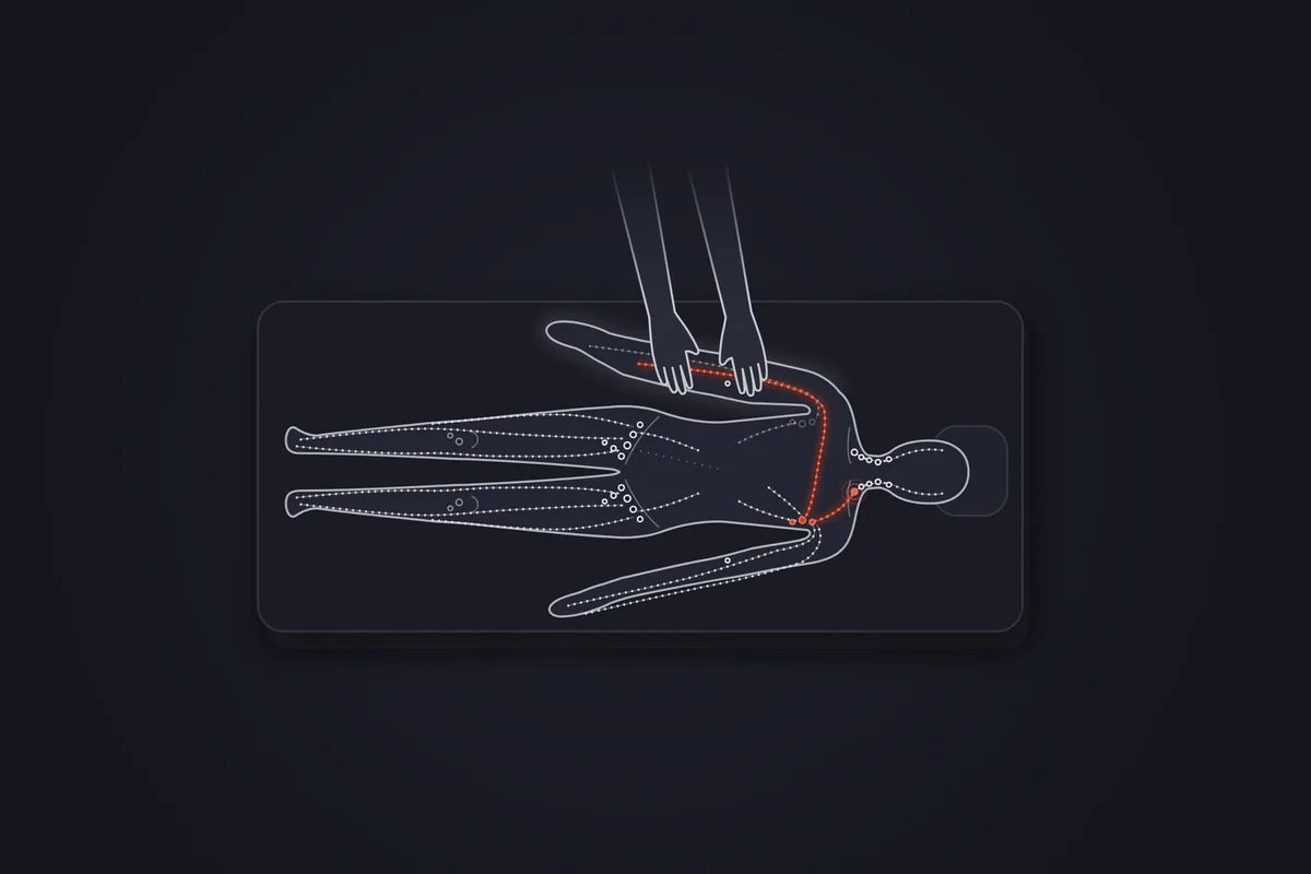 Illustration&nbsp;: patient allongé sur le dos, vu de dessus, dont le bras droit est plus volumineux que le gauche. Les mains d'un kinésithérapeute sont posées sur l'avant-bras et le coude gonflés. Un chemin rouge part du bras, passe au-dessus de l'aisselle opérée, traverse le haut du thorax jusqu'aux ganglions de l'aisselle opposée et finit à la base du cou.