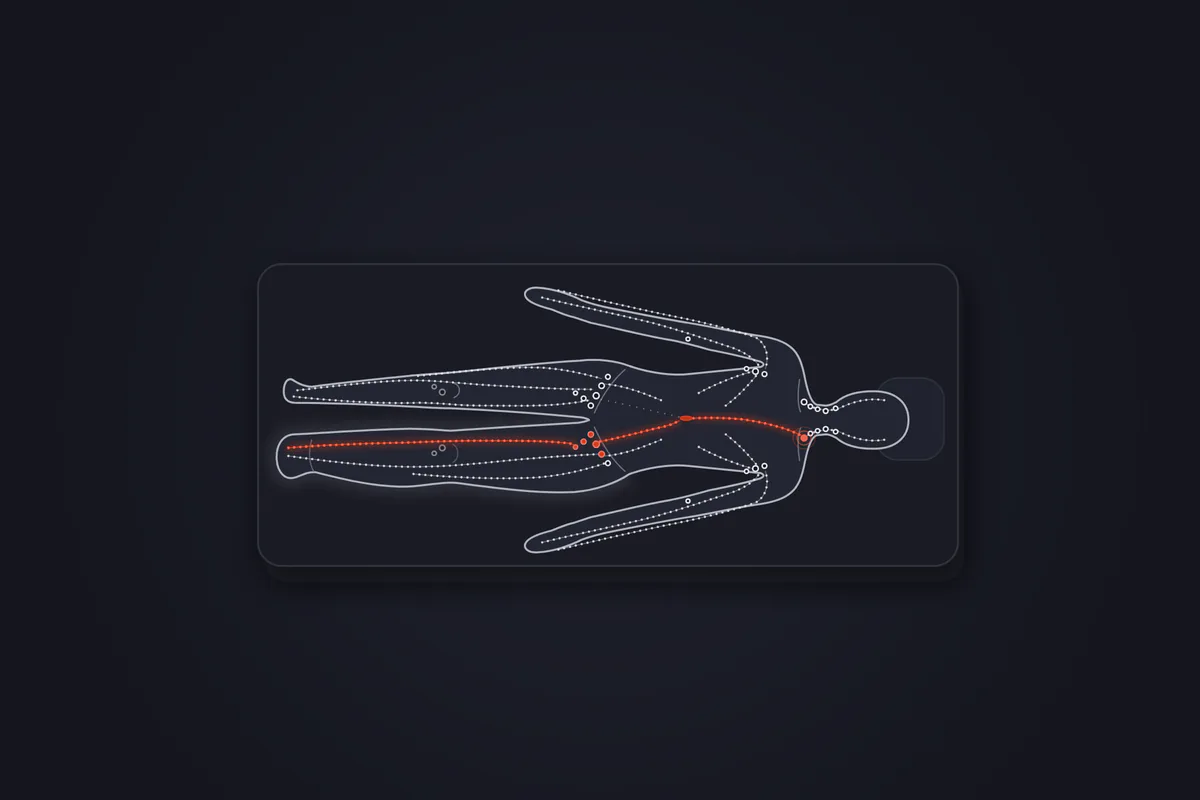 Illustration&nbsp;: patient allongé vu de dessus sur une table de soin, la jambe gauche plus volumineuse que la droite du pied jusqu'à la cuisse. Un trajet rouge remonte de ce pied par la face interne de la jambe jusqu'aux ganglions de l'aine, puis gagne la base du cou. Le reste du réseau lymphatique est en pointillés gris.