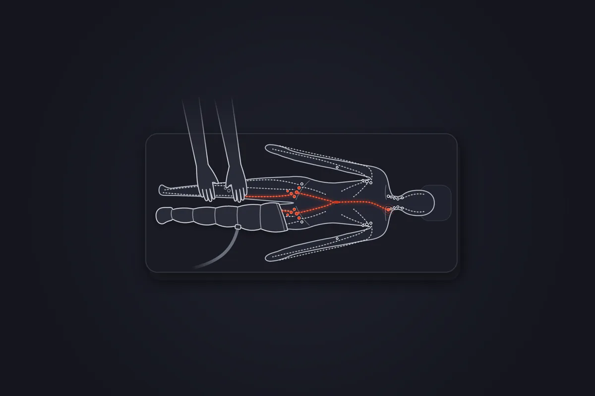 Illustration&nbsp;: patient allongé sur le dos vu de dessus, une jambe dans une botte de pressothérapie à compartiments reliée à un tuyau, l'autre sous les mains d'un kinésithérapeute&nbsp;; un tracé rouge montre la lymphe des deux jambes qui rejoint les ganglions de l'aine, puis remonte par le canal thoracique jusqu'à la base du cou, côté gauche.